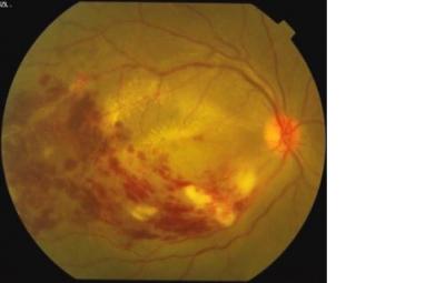 Figure 1: Photograph of the fundus of the right (a) and left (d) eyes showing severe vasculitis and macular oedema (arrow), with corresponding macular elevation on OCT macula (c and f). Photos (b) and (e) show the scan cut at which macula elevation is seen.